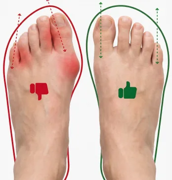 Foot comparison showing bunion and restricted toe box on left versus healthy wide natural toe box on right